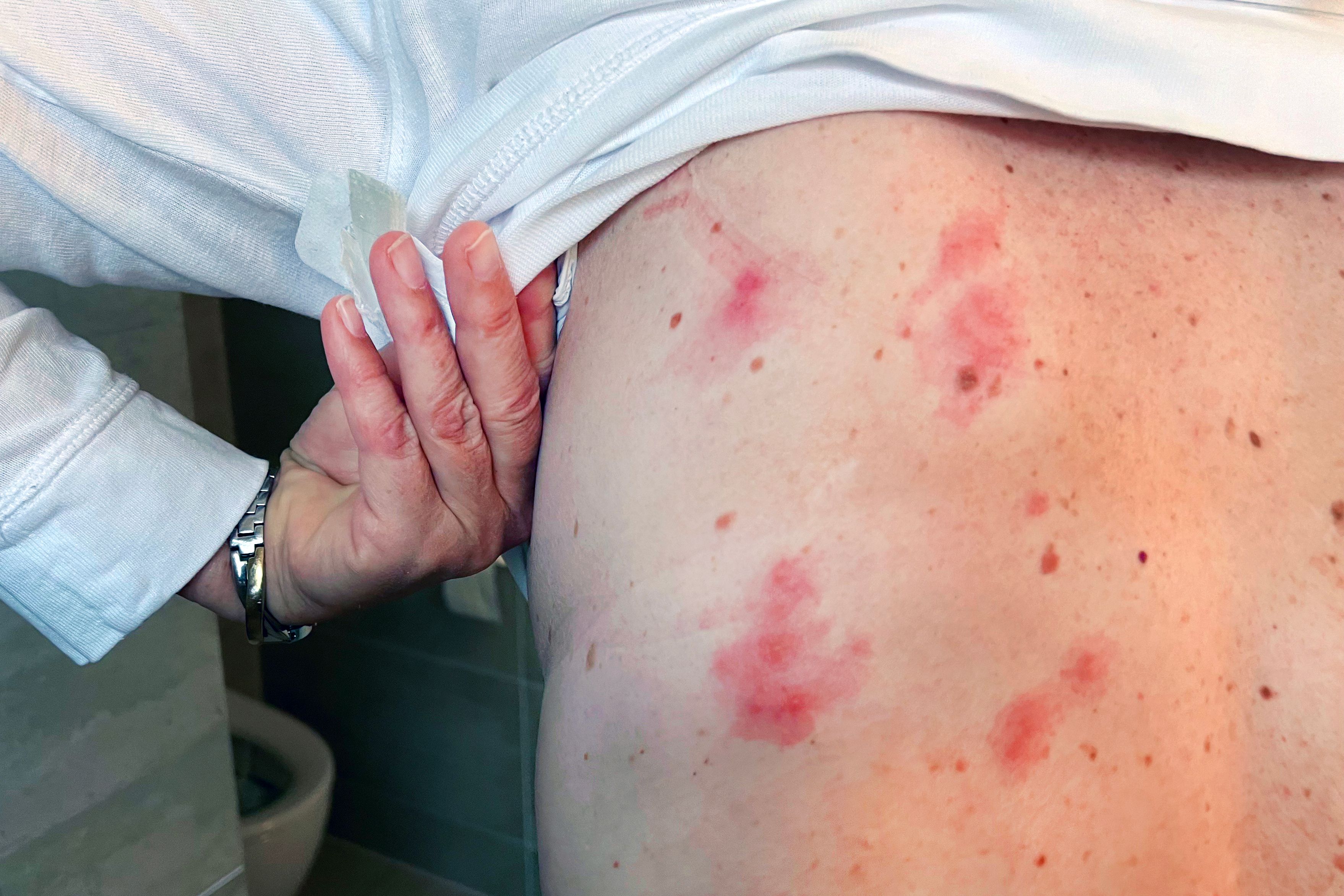 Utbruddene er på vei opp: – Dette unner du ikke din verste fiende